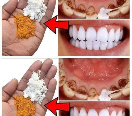 Remedios naturales con clavo y hojas de laurel para una sonrisa más brillante…