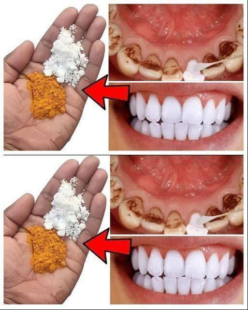 Remedios naturales con clavo y hojas de laurel para una sonrisa más brillante…